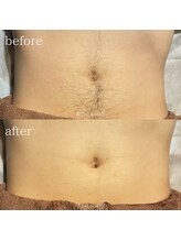 ピーディーエーサロン(PDA salon)/おへそ周り脱毛