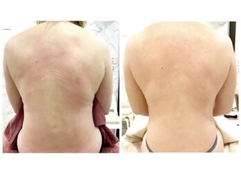 ビノスビューティー(vinos.beauty)/上半身　痩身