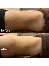 ラルーチェ(LaLuce)/腸リンパ