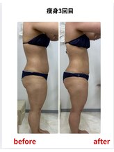 ステラ(Stella)/痩身3回目