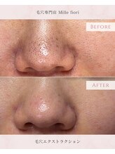 ミルフィオリ(Mille fiori)/毛穴エクストラクション