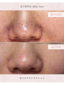 ミルフィオリ(Mille fiori)/毛穴エクストラクション