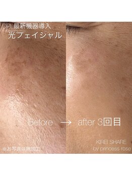 キレイシェア バイ プリンセスローズ静岡駅店(KIREI SHARE)/フェイシャル