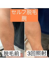 みつばちさろん/【セルフ脱毛】施術例「うで」