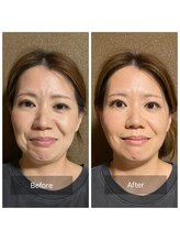 めいてる/小顔矯正＋美容鍼でここまで変化