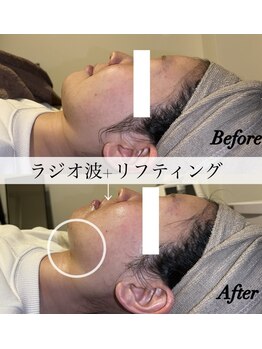 ステラ(Stella)/ラジオ波+リフティング