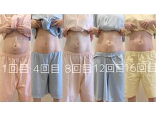 アカシア鍼灸整骨院/ぽっこりお腹がスッキリ♪