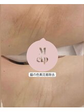 クプラニ 美浜店(kupulani)/メラニンケア(脇)