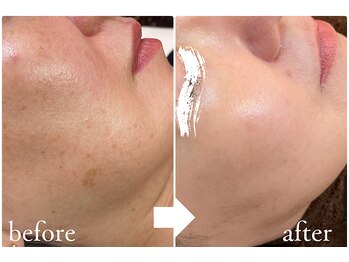 シミケア専門店　肌管理ラボ　RaPur/ホワイトニングケア