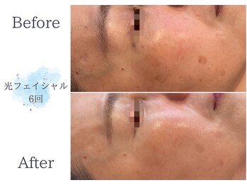 ディアスマイル(Dear.smile)/光フェイシャル6回