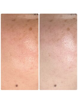 ラウレア(Laule'a)/津山|くすみケア透明感アップ