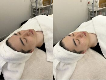 ミイン(miin)/メンズハイパーフェイシャル