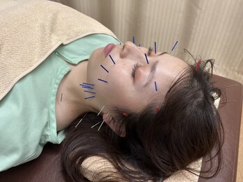 骨盤スタイル鍼灸整骨院 イオン 札幌元町院/☆美容鍼☆