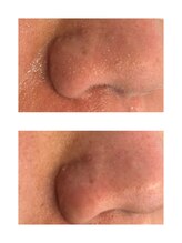 ピノ 西尾店(PINO)/【メンズフェイシャル】毛穴洗浄