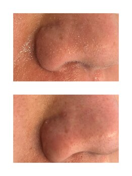 ピノ 西尾店(PINO)/【メンズフェイシャル】毛穴洗浄