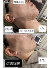 ミーアップ(Me up)/ニキビ専門サロン/天王寺