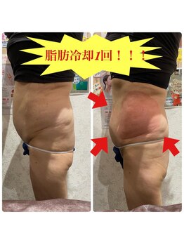 プリマプリート WEST店/脂肪冷却