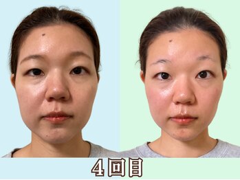 ナチュラルパーフェクトフェイス 新宿/４回目もっとキレイに/新宿小顔