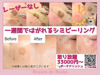 ボーテドリッシュ(Beaute de Riche)/小顔矯正メンテナンスB→A