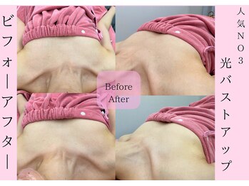 Cスキンケアクリニック 麻布店/光バストケアBeforeAfter
