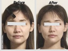 ショウフェイスデザイン(Sho Face Design)/《小顔矯正》ビフォーアフター