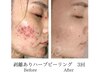【リベル剥離ハーブピーリング】福井初！美肌の最終兵器、根深い悩みを解消！