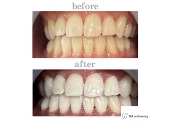 NAホワイトニング 自由が丘店/【before/after】