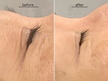 お肌をキレイにしたいならコレ！肌質改善フェイシャル☆