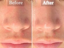 ボーンオム(Born Homme)/毛穴洗浄＋美容液導入：20代女性