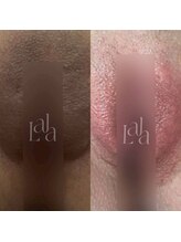 シャリテ(Charite)/ララピンク　デリケートゾーン