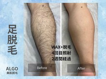 アルゴ 山口宇部店(ALGO)/脱毛初めて！4回目でこの効果！