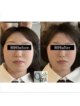 キュープ 下関店(Qpu)の写真/オールハンド施術で痛みのないじんわり指圧◎たった２０分、お顔の左右差、もたつき、凝りがスッキリ◎