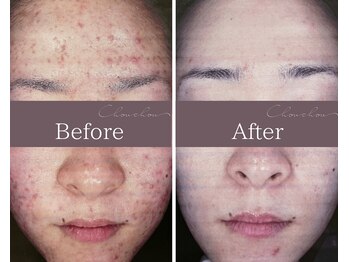 シュシュ(Chou chou)/【Before★After】ニキビ改善