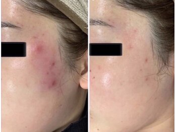 コンフィデンスサロン(Confidence Salon)/プラズマシャワーB&A