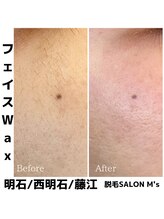 エムズ(M's)/お顔まるごと脱毛人気です