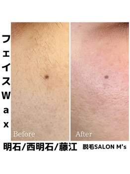 エムズ(M's)/お顔まるごと脱毛人気です