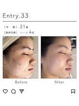 ビューティリュクス(beauty luxe)/肌荒れあとのケアも得意です！！