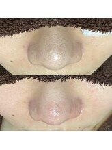 エクラ バイ シャンリィ(eclat by shanLy)/夏綺麗なお肌に