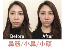 ラプリ 盛岡店(Raplit)の雰囲気（美しくスッキリした小鼻/小顔◎他の症例もフォトギャラリーに有）