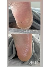 フットミー(foot mii)/かかとケア サンダル時期も◎