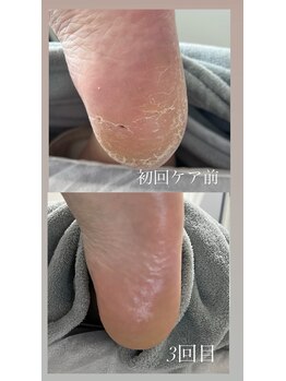 フットミー(foot mii)/かかとケア サンダル時期も◎