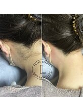 ブラジリアンワックス脱毛サロン ルラ 恵比寿(Lula)/うなじワックス/Before &after