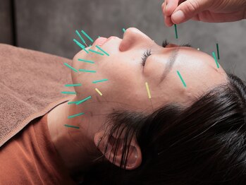 めいてるの写真/国家資格者による鍼灸で、疲労・睡眠・自律神経のお悩みに対応