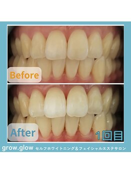 グロウ グロウ(grow.glow)/仙川ホワイトニング