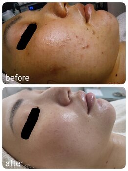 レゾン 京橋店/【ビフォーアフター】ニキビケア