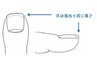 【巻き爪対策】巻き爪予防ができる★足の爪切り1箇所¥550