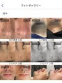 スキンジム(SKIN GYM)&nbsp;後悔のないサロン選びのために【フォト】で効果をご確認ください