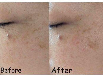 マインドール/目尻のシワ、シミ変化!