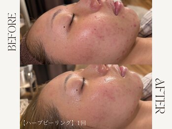 ルカ 北堀江(Luca)の写真/韓国肌管理で憧れのツヤ肌へ!ハーブピーリングや毛穴ケアなど、最新の技術でノーファンデの艶肌へ◎