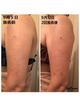 レナンセラ バイ カトレアグループ(Renanthera by カトレアGroup)/40代女BeforeAfter